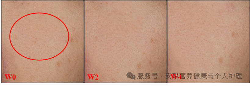 受试者（编号07）VISIA-CR自然光图像比照